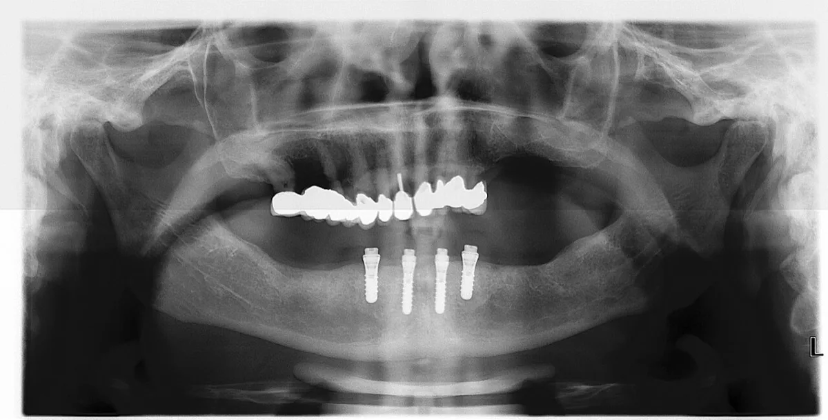 Prótese fixa do protocolo sobre implantes, feita pelo Dr. Eric Daldegan em Niterói