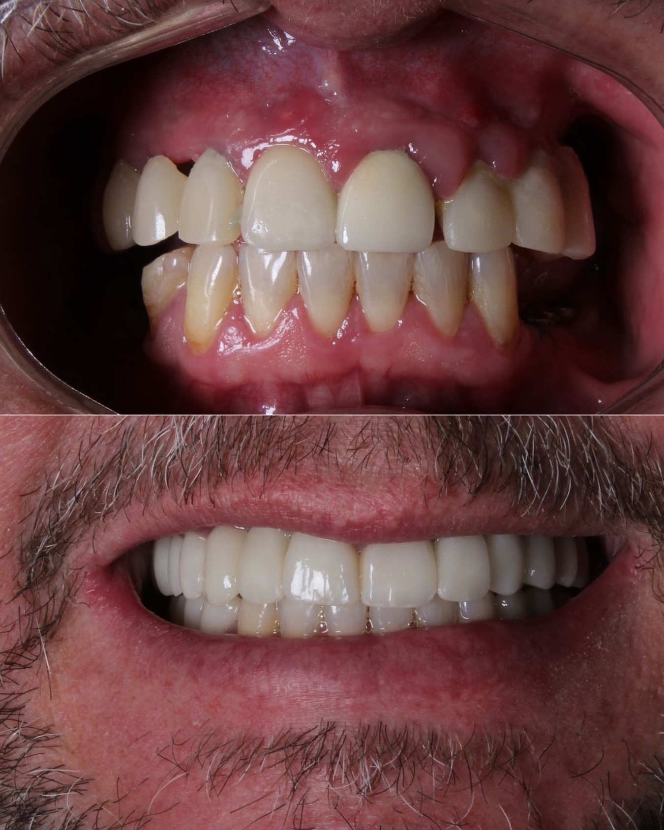 Antes e depois de facetas de porcelana na Daldegan Odontologia, Niterói